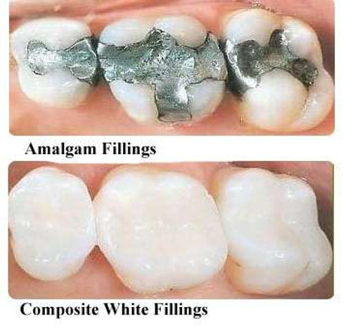 amalgam-composite-fillings