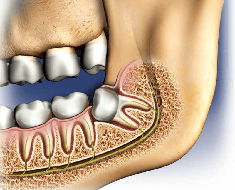 removing-wisdom-teeth-illustration